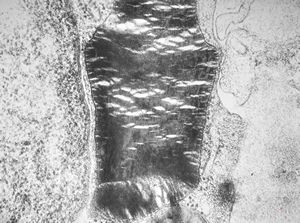 M,27y. | sea-blue histiocyte syndrome M,27y. | sea-blue histiocyte syndrome